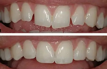 Tooth difference photos