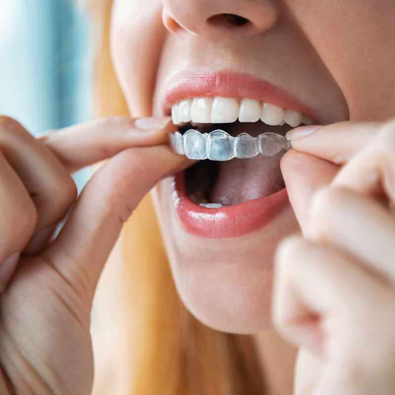 woman inserting invisalign