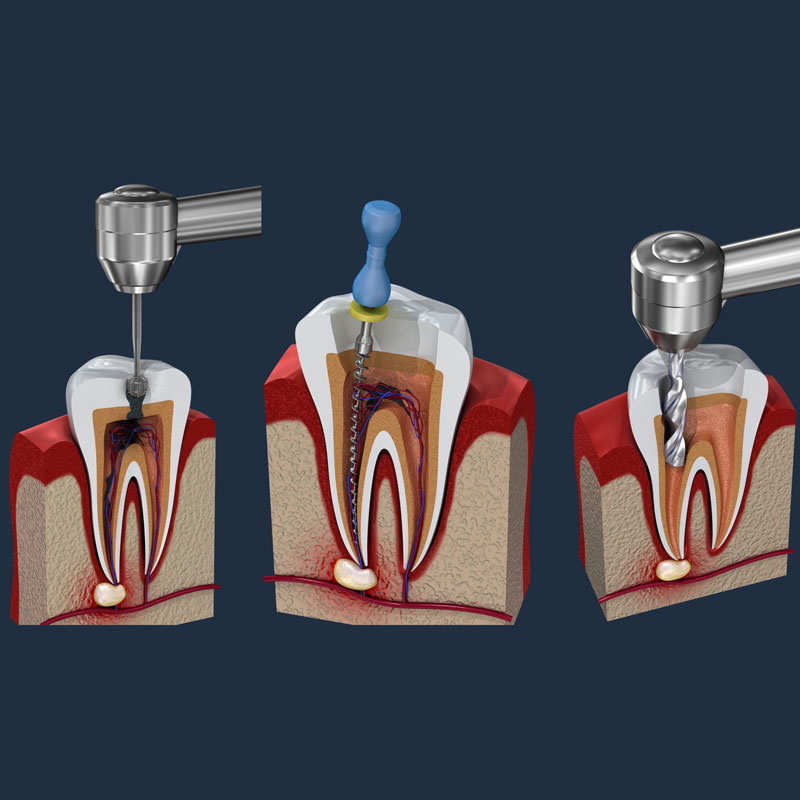 RCT treatment