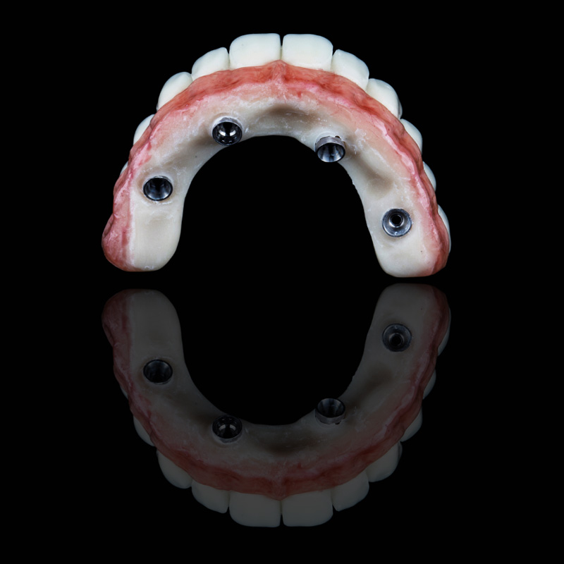 all-on-4 denture
